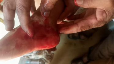 রাঙামাটির বাঘাইছড়িতে বন্দুকযুদ্ধে শিশু গুলিবিদ্ধ