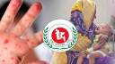 হাম সন্দেহে ও নিশ্চিত হামে ২৪ ঘণ্টায় ৪ মৃত্যু