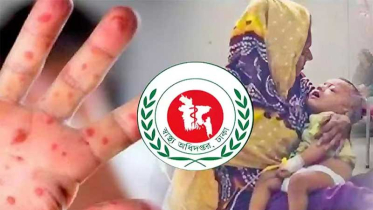 হাম সন্দেহে ও নিশ্চিত হামে ২৪ ঘণ্টায় ৪ মৃত্যু