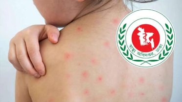 হামের উপসর্গে ২৪ ঘণ্টায় ৯ মৃত্যু, হাসপাতালে ১ হাজার ৩৪১